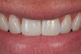 Dental Implant and Crown - After | Greenwich CT Dentist | Greenwich Cosmetic Dentistry