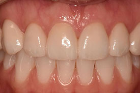 Invisalign & Veneers - After | Greenwich CT Dentist | Greenwich Cosmetic Dentistry