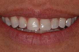 Invisalign Invisible Braces - After | Greenwich CT Dentist | Greenwich Cosmetic Dentistry