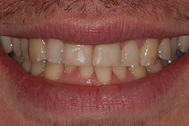 Invisalign & Veneers - Before | Greenwich CT Dentist | Greenwich Cosmetic Dentistry