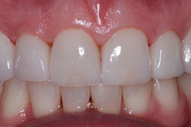 Invisalign & Veneers - After | Greenwich CT Dentist | Greenwich Cosmetic Dentistry