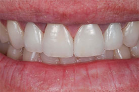 Veneers and Ceramic Crowns - After | Greenwich CT Dentist | Greenwich Cosmetic Dentistry