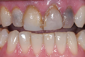 Veneers and Ceramic Crowns - Before | Greenwich CT Dentist | Greenwich Cosmetic Dentistry